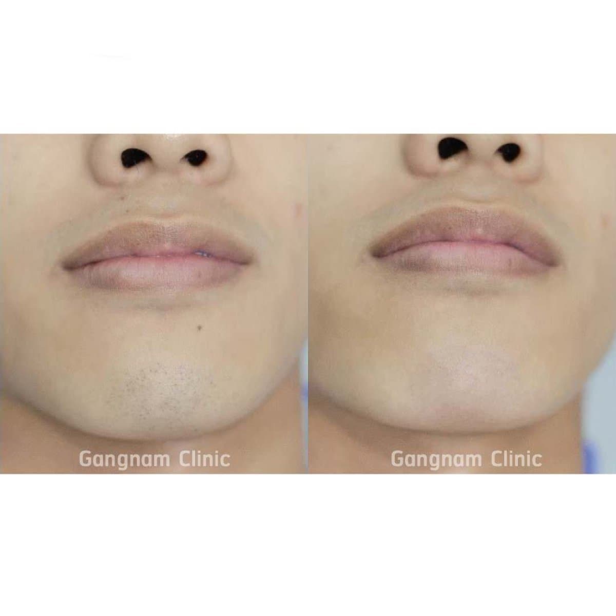 laser hair removal