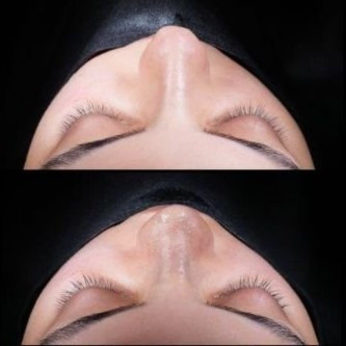 tip rhinoplasty
