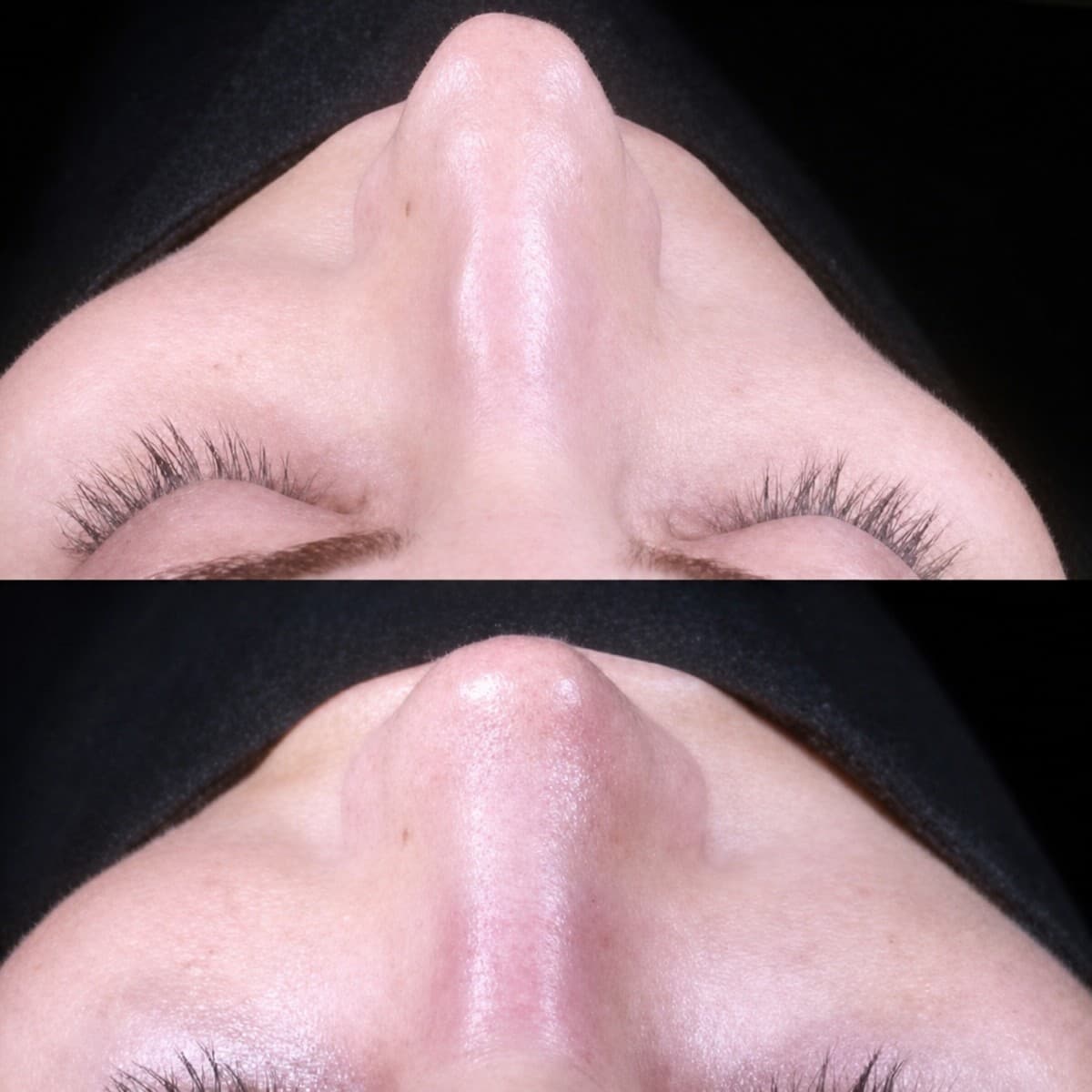 tip rhinoplasty