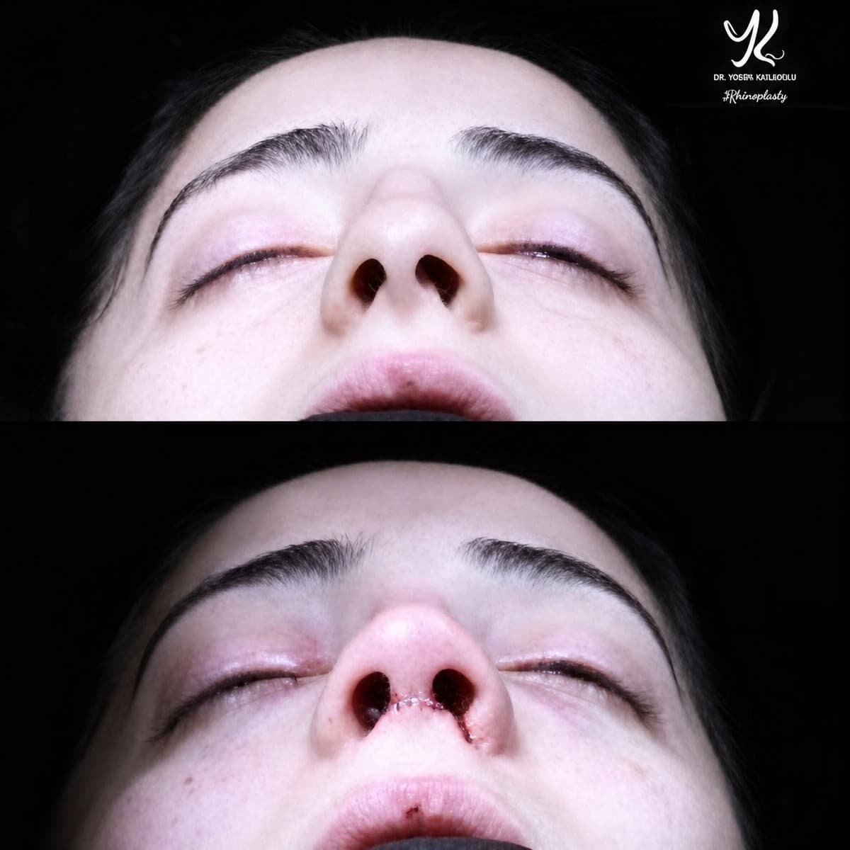 tip rhinoplasty
