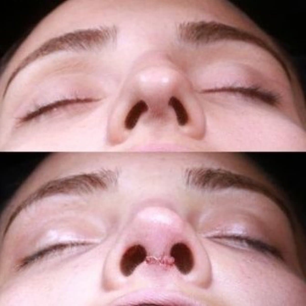 tip rhinoplasty