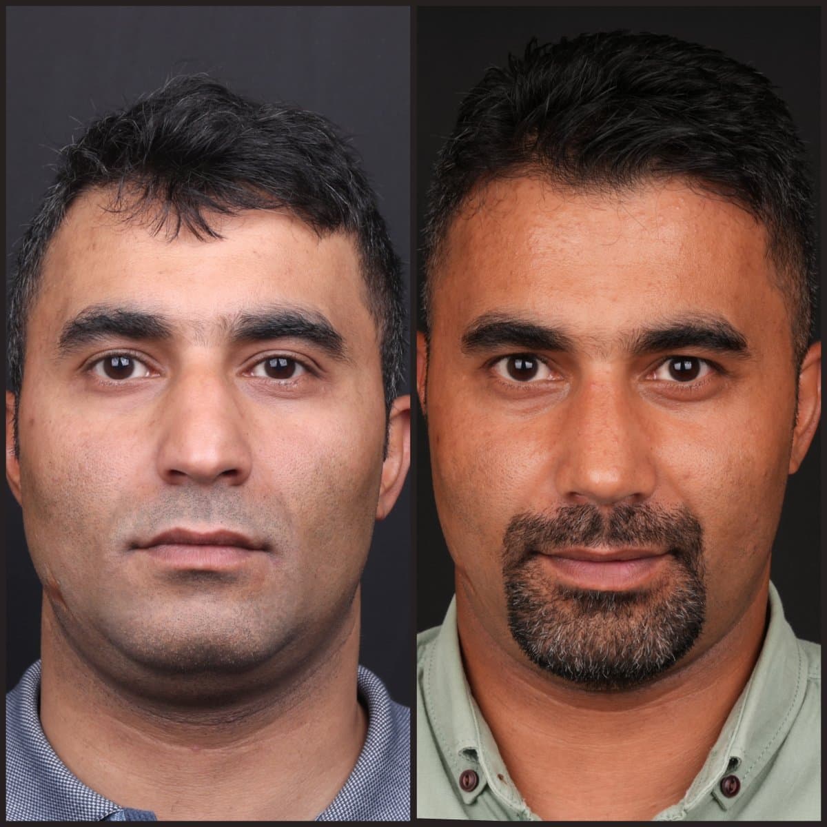 FUE hair transplant