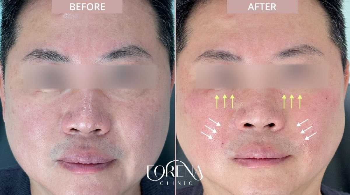 fillers injection