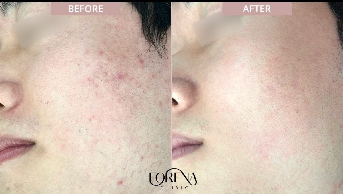 acne scar treatment