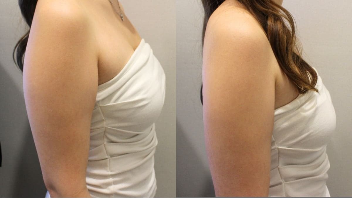 liquid liposuction arm contouring