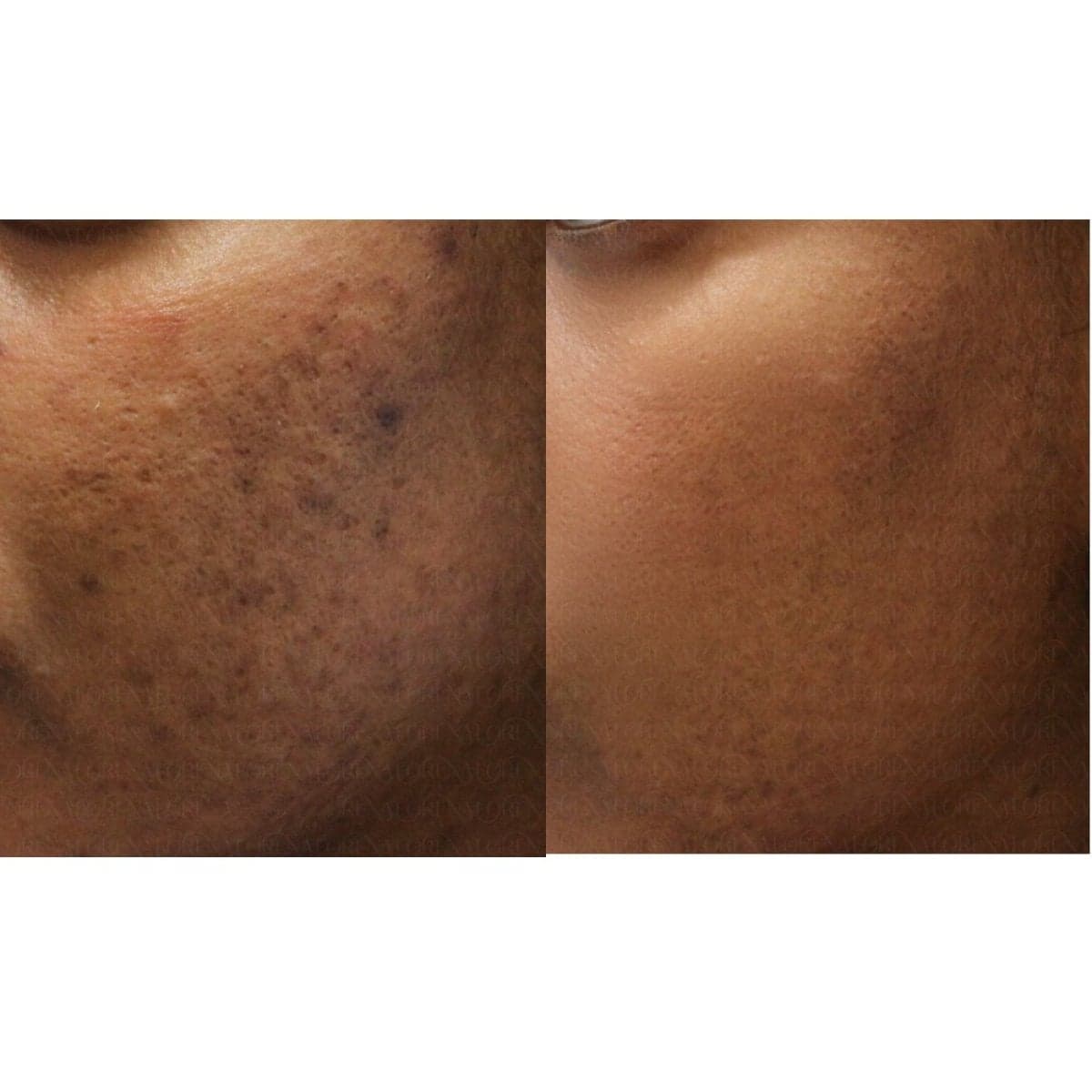 acne scar treatment