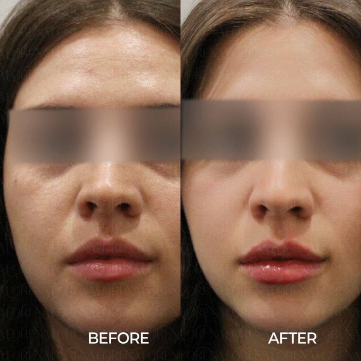laser skin resurfacing