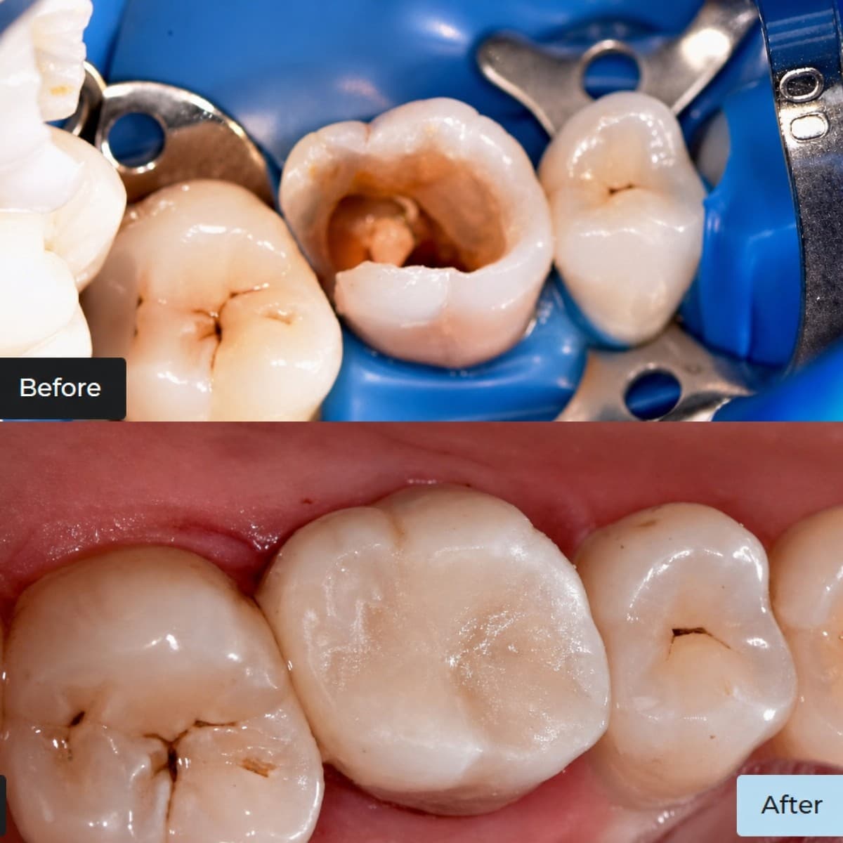 composite filling