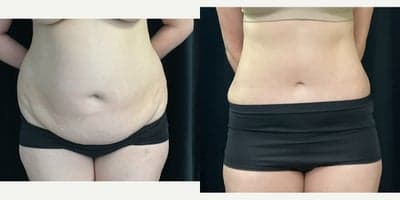 35-44 year old woman treated with Tummy Tuck, Liposuction
