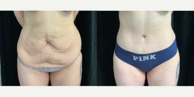 18-24 year old woman treated with Tummy Tuck, Liposuction