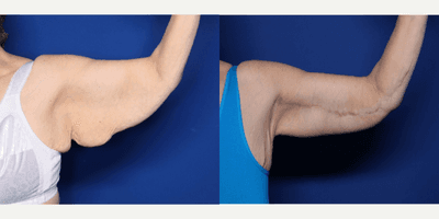 55-64 year old woman treated with Arm Lift