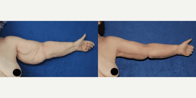 55-64 year old woman treated with Arm Lift