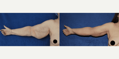 55-64 year old woman treated with Arm Lift