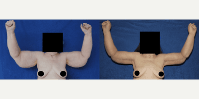 55-64 year old woman treated with Arm Lift