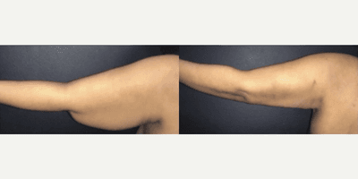 Woman treated with Arm Lift