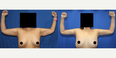 45-54 year old woman treated with Arm Lift