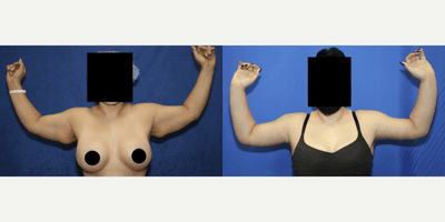 35-44 year old woman treated with Arm Lift