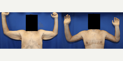 25-34 year old man treated with Arm Lift