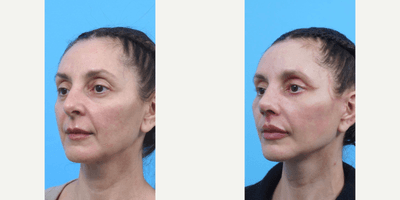 Woman treated with Eyelid Surgery, Facelift, Neck Lift, Lip Lift, Lip Implants, Rhinoplasty