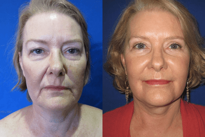 50-59 year old woman treated with Lip Implants