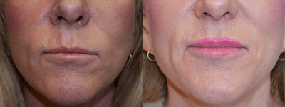 50-59 year old woman treated with Lip Implants