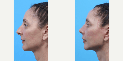 Woman treated with Eyelid Surgery, Neck Lift, Lip Lift, Lip Implants, Facelift, Rhinoplasty