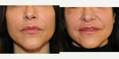 35-44 year old woman treated with Lip Implants