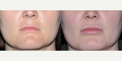 32 year old woman treated with Lip Implants.