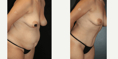 35-44 year old woman treated with Tummy Tuck, Liposuction, Lip Implants