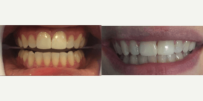 25-34 year old woman treated with Zoom Whitening