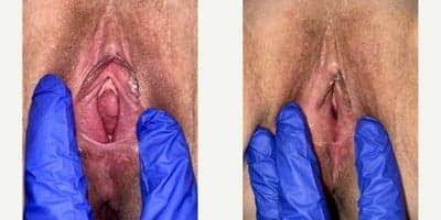 55-64 year old woman treated with Vaginoplasty, Perineoplasty