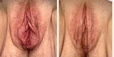 45-54 year old woman treated with Labiaplasty, Clitoral Hood Reduction, Vaginoplasty, Perineoplasty