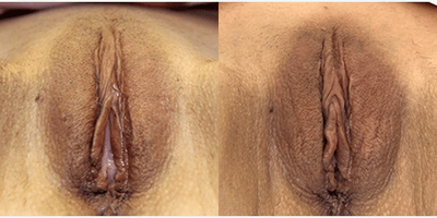 35-44 year old woman treated with Labiaplasty