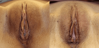 35-44 year old woman treated with Labiaplasty