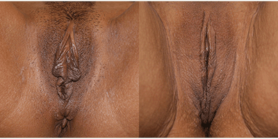 31 year old woman treated with Labiaplasty