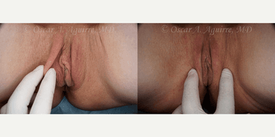 57 yo had Labiaplasty of minora & majora,Clitoral Hood Reduction w/Clitoropexy,PRP to surgical Wound