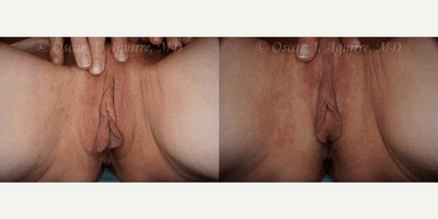 57 yo had Labiaplasty of minora & majora,Clitoral Hood Reduction w/Clitoropexy,PRP to surgical Wound