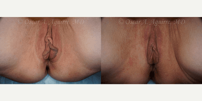 57 yo had Labiaplasty of minora & majora,Clitoral Hood Reduction w/Clitoropexy,PRP to surgical Wound