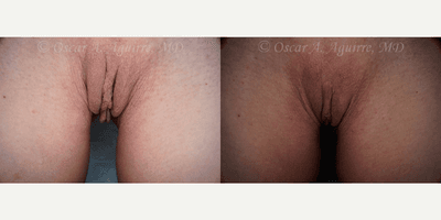 57 yo had Labiaplasty of minora & majora,Clitoral Hood Reduction w/Clitoropexy,PRP to surgical Wound