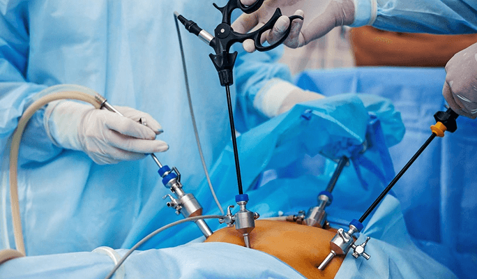 Uterine Removal