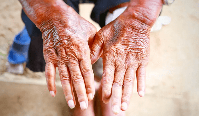 Stem Cell Treatment for Multiple Sclerosis