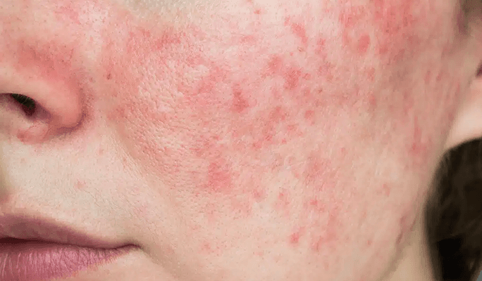 Stem Cell Therapy for Lupus