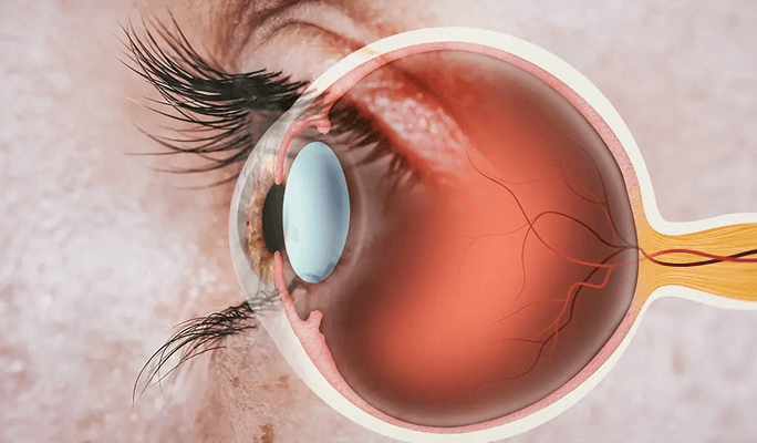 Corneal Rings