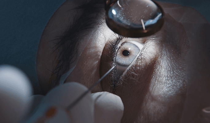 Presbyopia