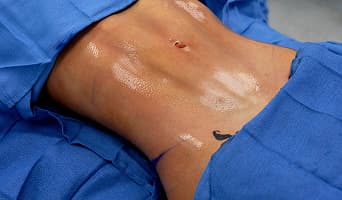 Abdominal Etching
