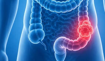 Colon Cancer