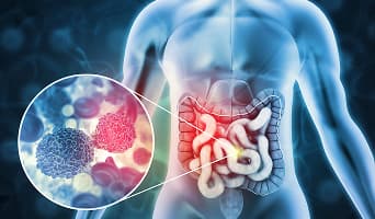 Colorectal Cancer