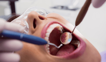 Dental Fillings