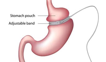 Gastric Banding
