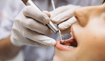 Gingivectomy